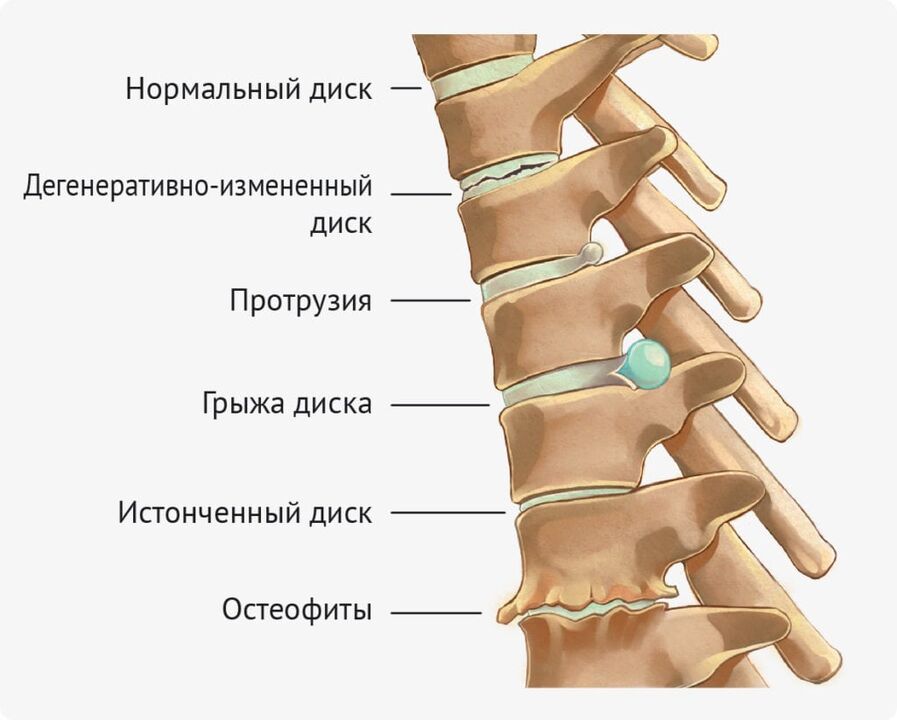 Discount deformities for the osteochondrosis lumbar