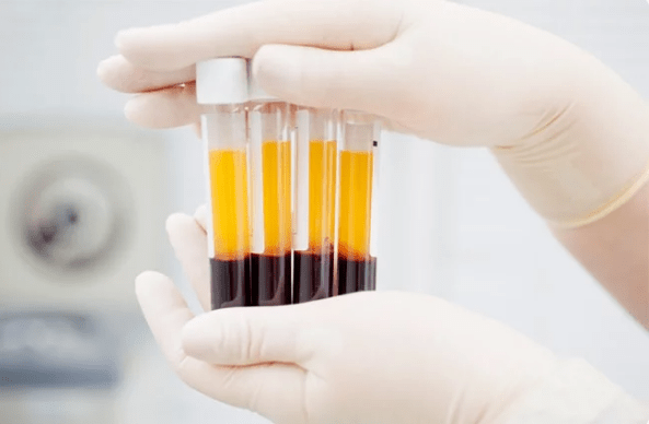 PRP therapy
