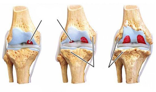 Grading arthrosis