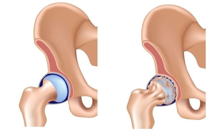 Healthy joint and joint with osteoarthritis