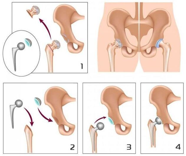 Replacement of a painful connection with a prosthesis