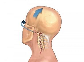 How osteochondrosis of the cervical spine manifests itself
