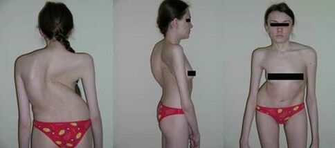 Craumatic of the spine as a result of osteochondrosis