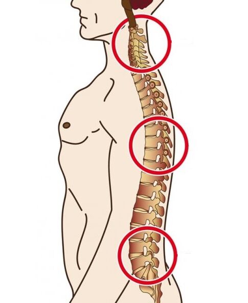 Spinal departments in which osteochondrosis occurs