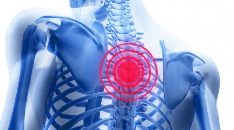 Back pain can be due to a herniated disc
