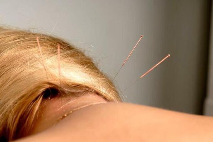 Acupuncture for osteochondrosis
