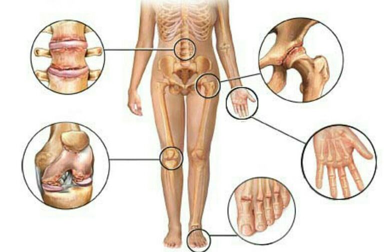 Type and degree of osteoarthritis