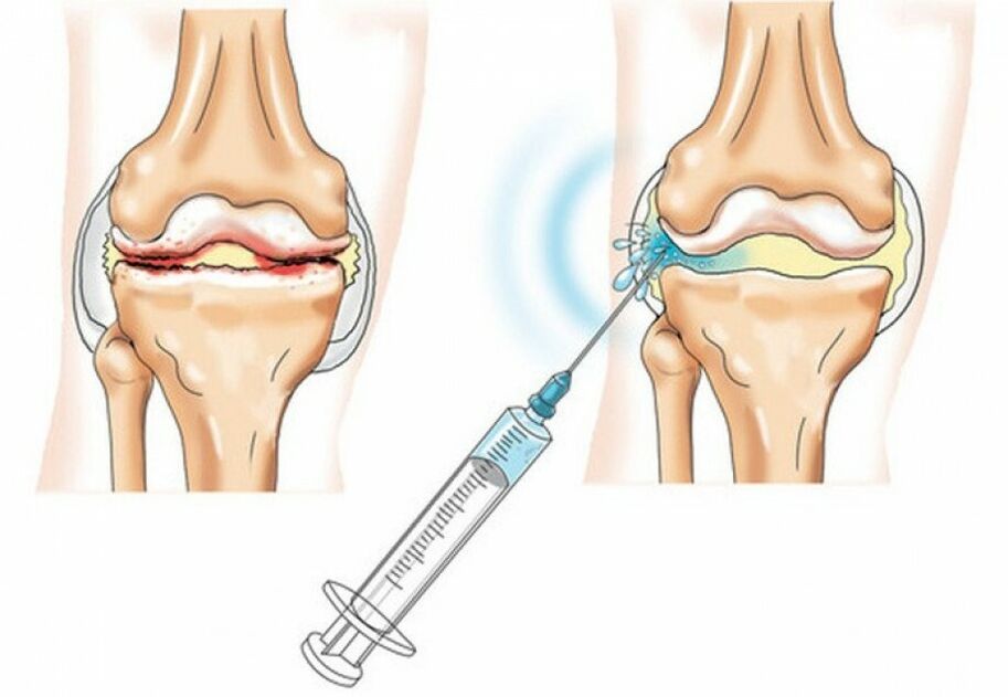 Injection into the knee joint for arthrosis