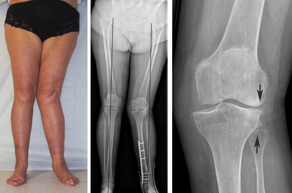 Advanced osteoarthritis of the knee joints can be clearly seen visually even without an X-ray