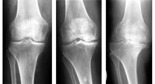 An obligatory diagnostic measure to determine knee arthrosis is an x-ray