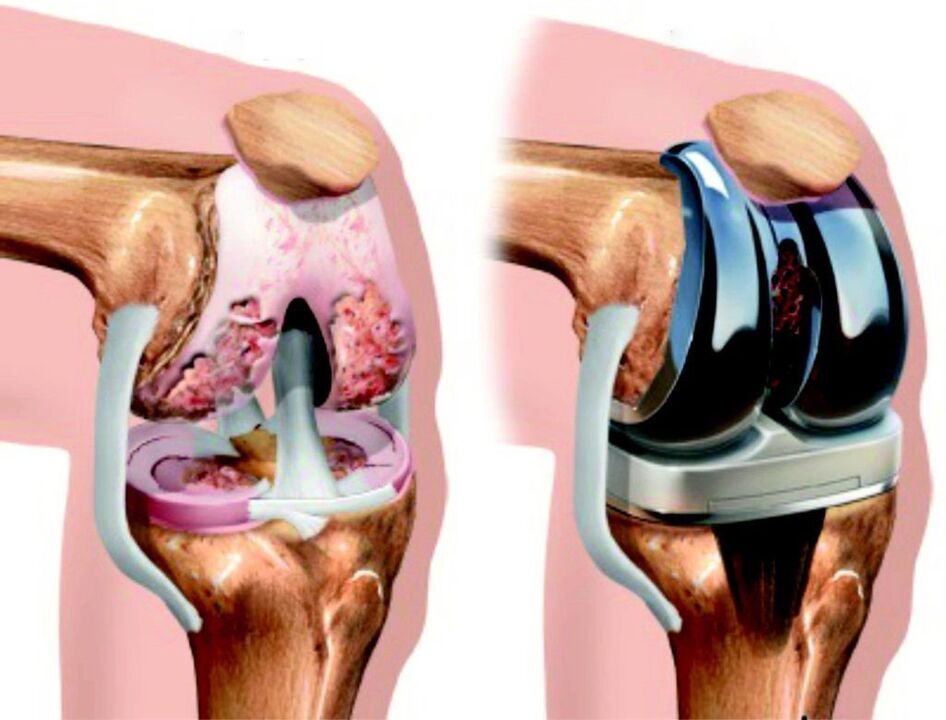 If the knee joint is completely damaged by osteoarthritis, it can be restored using endoprosthetics